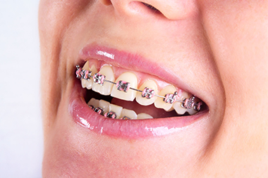 ortodoncija